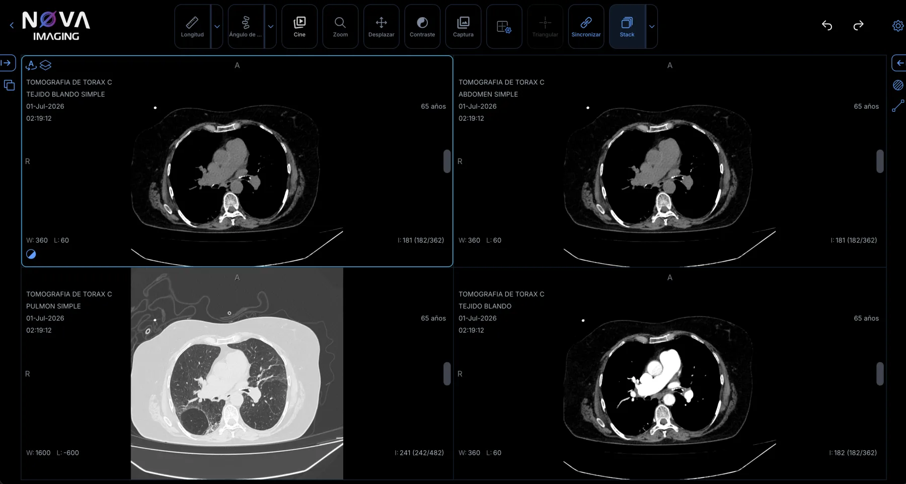 Visor DICOM nativo de NOVA Imaging: TC de tórax en cuatro paneles sincronizados (tejido blando, abdomen, pulmón) con herramientas de medición, ventana/nivel y cine.