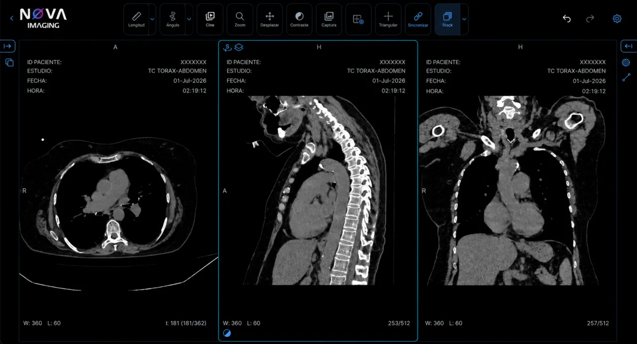 Visor NOVA Imaging: TC de tórax-abdomen en cortes axial, sagital y coronal